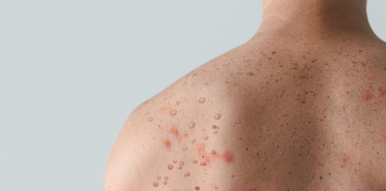 "No End in Sight" to Measles Outbreak in South Carolina 