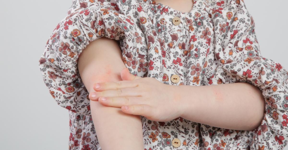 A child wearing a floral dress rubs their bug bite.