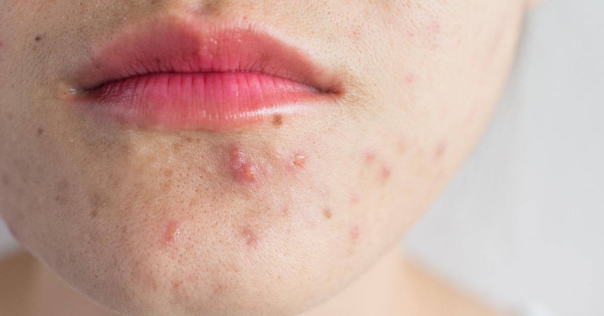 Does Plant Based Protein Cause Acne