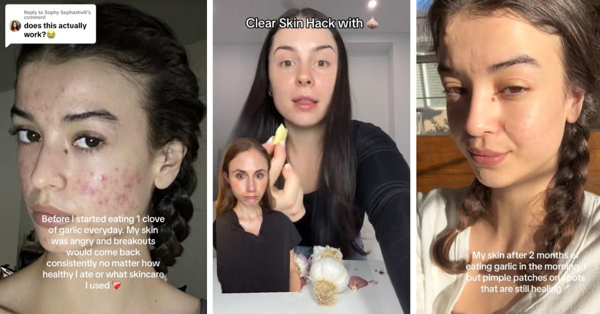 Users eating raw garlic to cure their acne