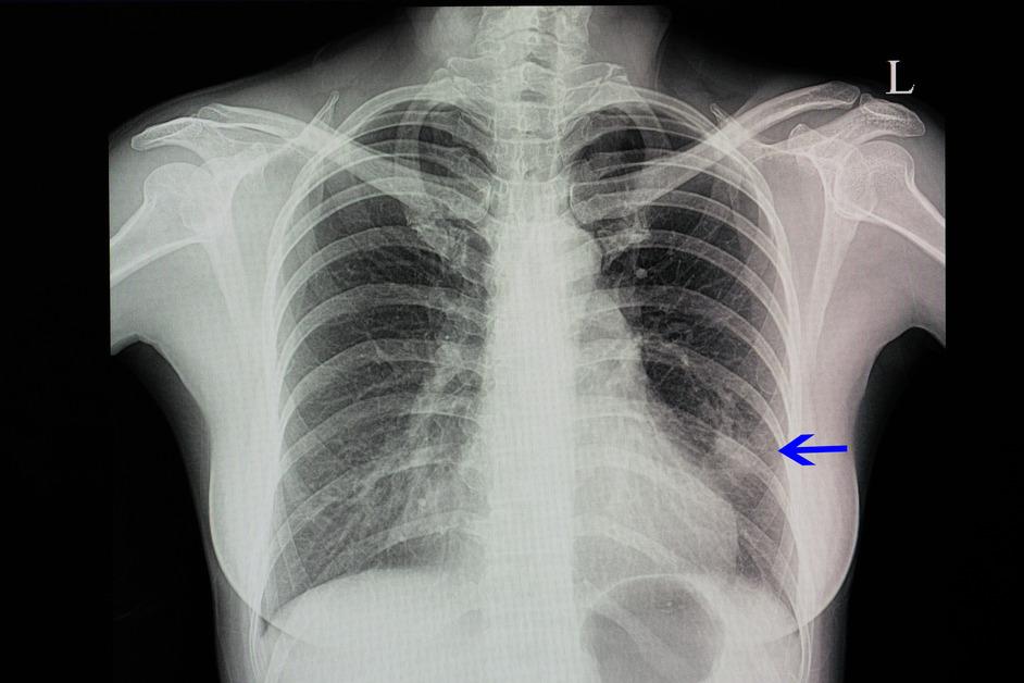 An x-ray of lungs with pneumonia with a blue arrow pointing to the white spot. 