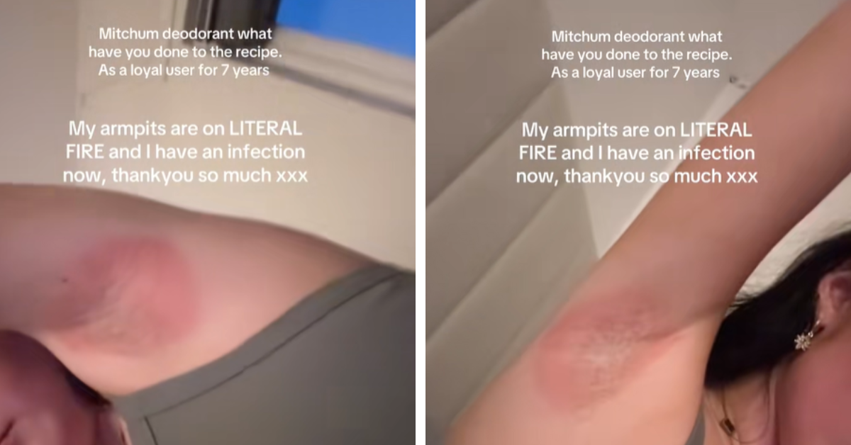 A woman shows the bright red rash and signs of infection she says she got from using Mitchum deodorant 