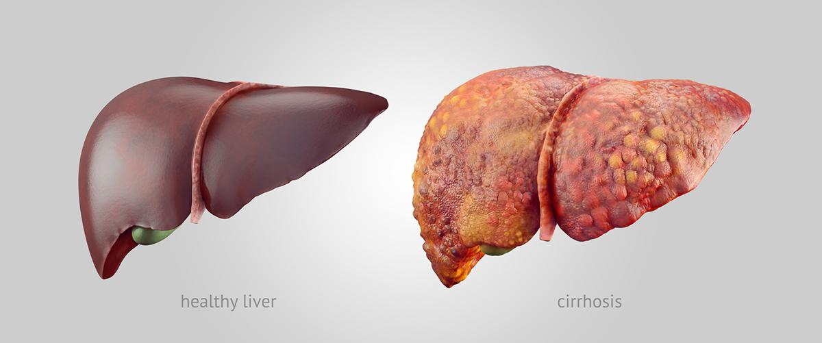 liver damage cirrhosis