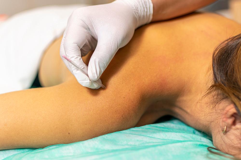 Dry needling being performed on a woman.