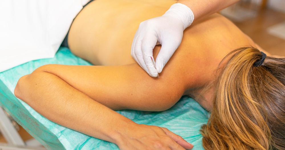 Dry needling being performed on a woman.