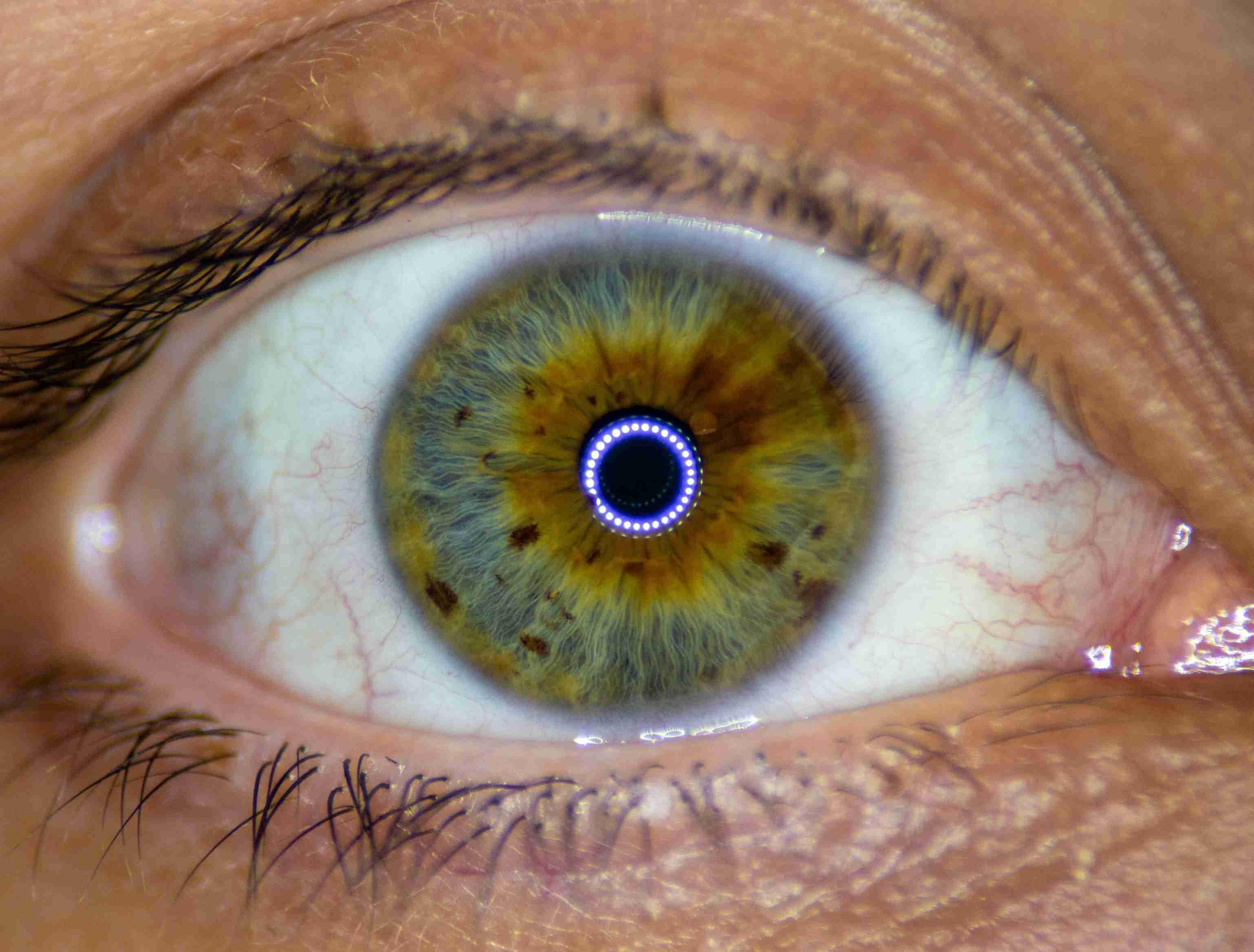 A close-up photo of a patient's eyeball reveals intricate colors.