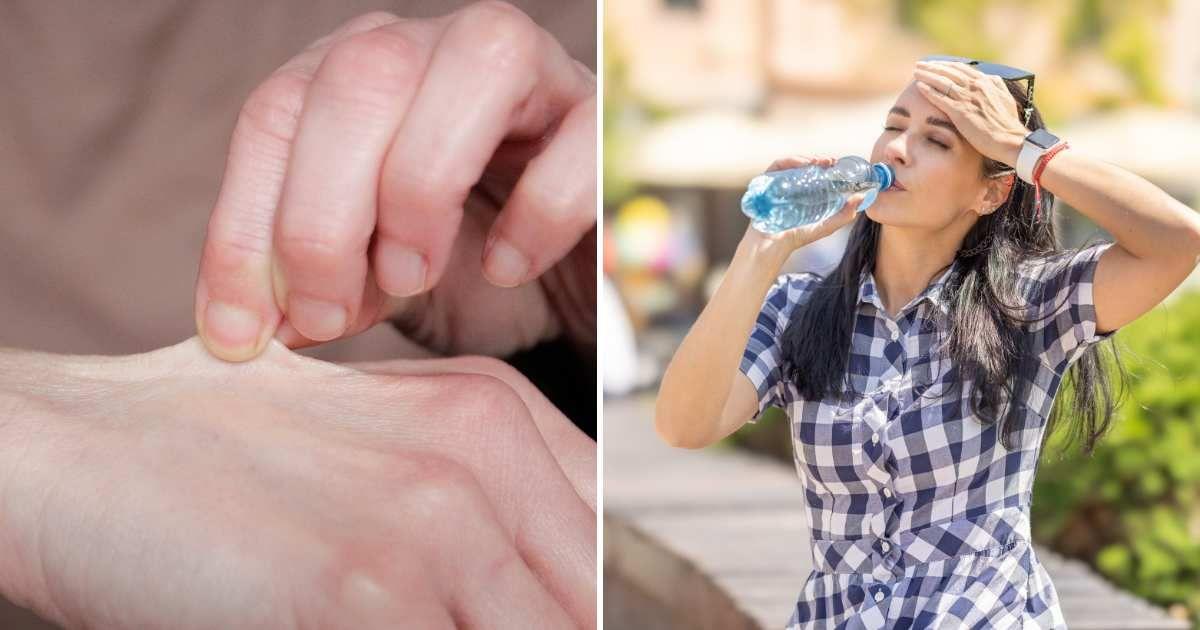 (L) Individual pinching the skin at the back of their hand. (R) A woman who has a headache due to dehydration drinks water. (Representative Cover Image Source: Getty Images | (L) Kinga Krzeminska. (R) Simple Images)