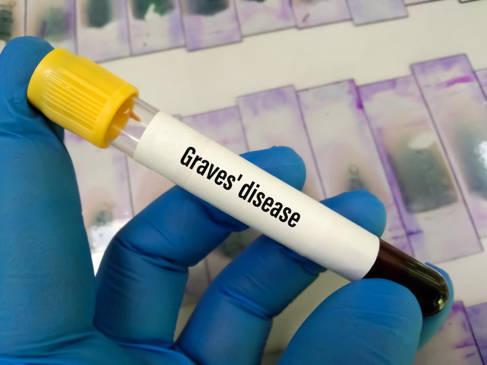 Graves' Disease Blood Vial