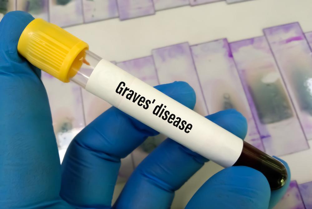 How Long Can You Live With Graves' Disease?