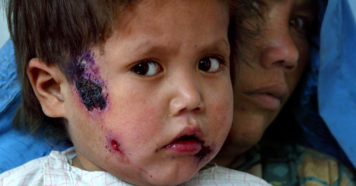 A boy with leishmaniasis on his face. 