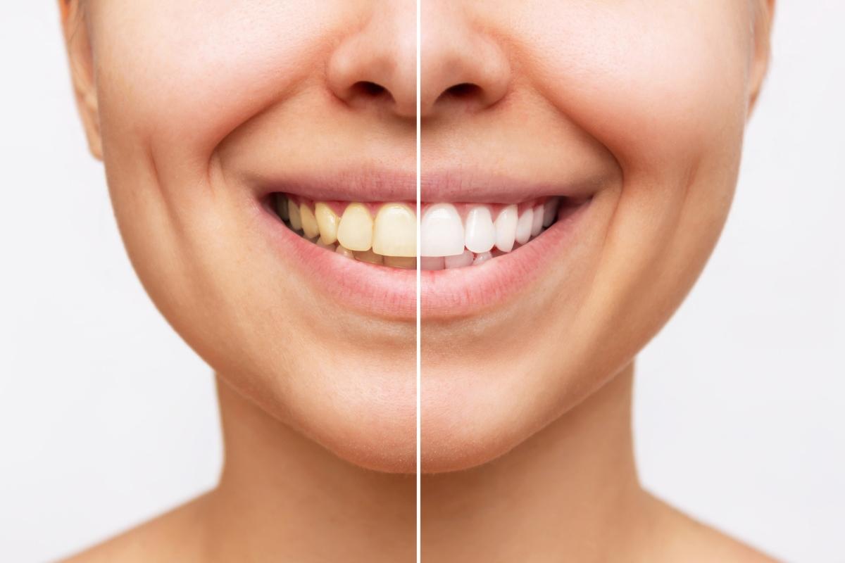 side-by-side comparison of yellow and white teeth