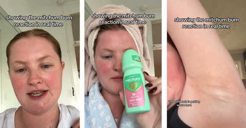 People Claim Mitchum Deodorant Is Burning Their Armpits