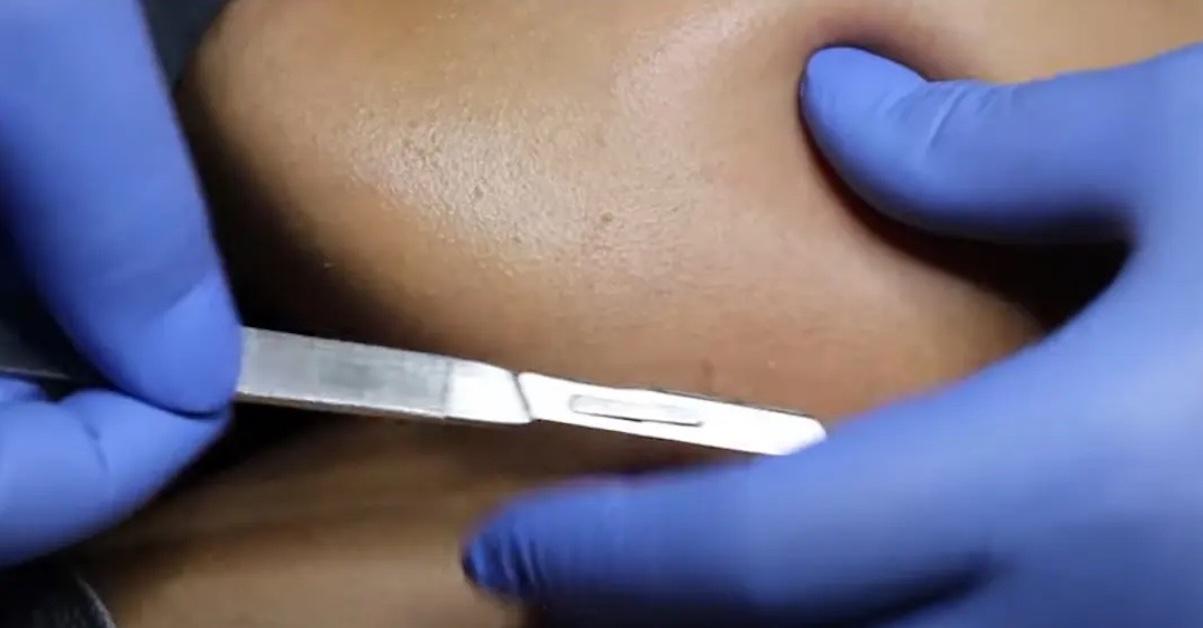 Gloved person gives dermaplaning treatment