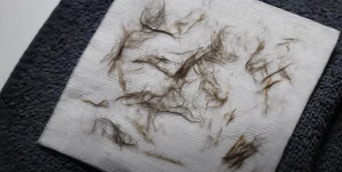 white cloth covered in hair removed by dermaplaning