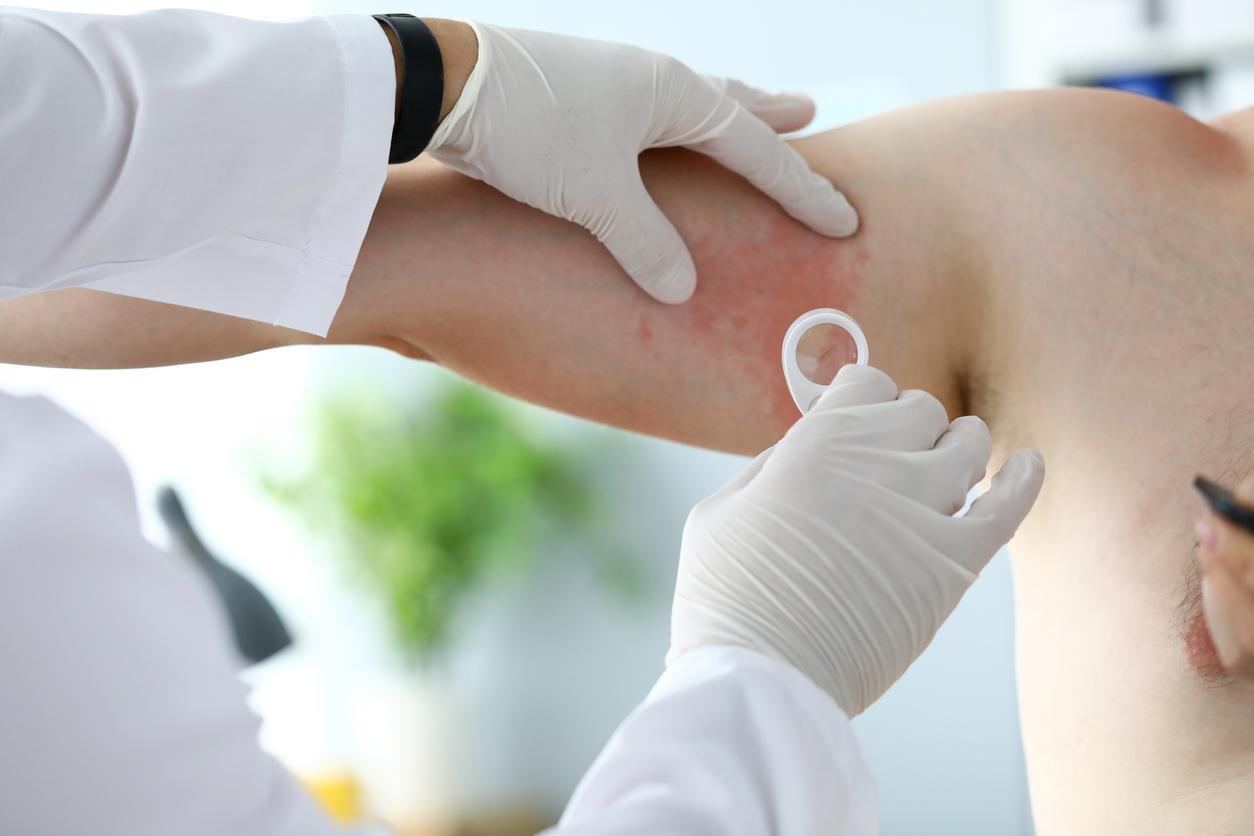 A dermatologist inspects red, inflamed skin on a patient's arm.