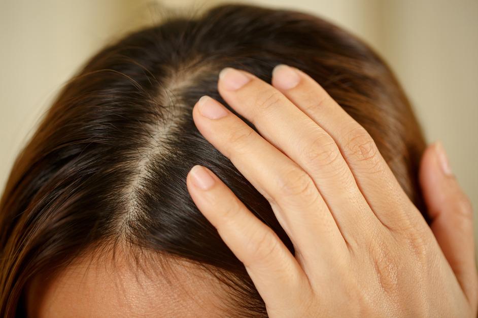 A person with dark hair holds the top of their scalp.