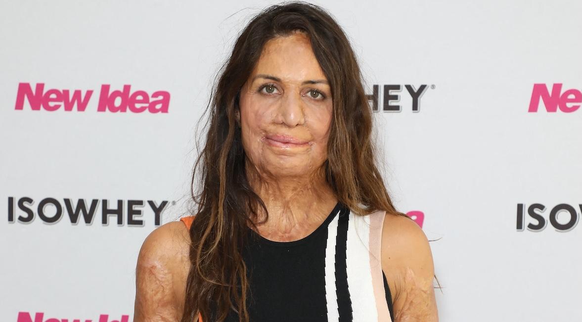 What Happened to Runner Turia Pitt?