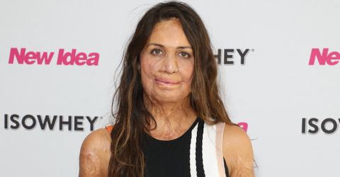 What Happened to Runner Turia Pitt?