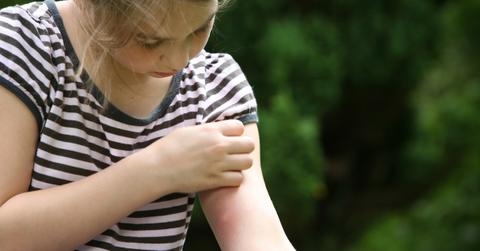 A child in a striped shirt scratches a mosquito bite on her arm