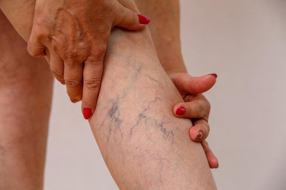 A person with red painted nails showing the back of their leg where their veins are very blue and visible.