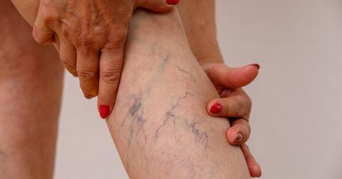 A person with red painted nails showing the back of their leg where their veins are very blue and visible.