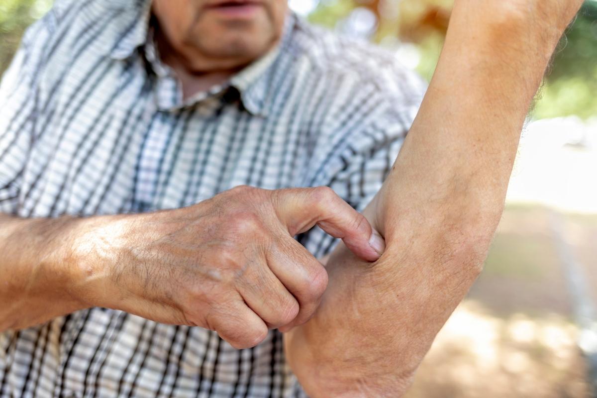 close-up of man in plaid shirt with bug bite on arm