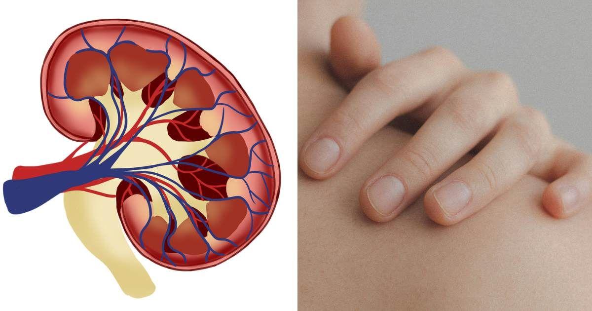 (L) An illustration of a kidney. (R) A woman touching her skin on the back. (Representative Cover Image Source: (L) Pixabay | Eksavang, (R) Pexels | Ximena Mora)