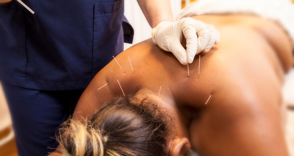 Dry needling being performed on a woman.