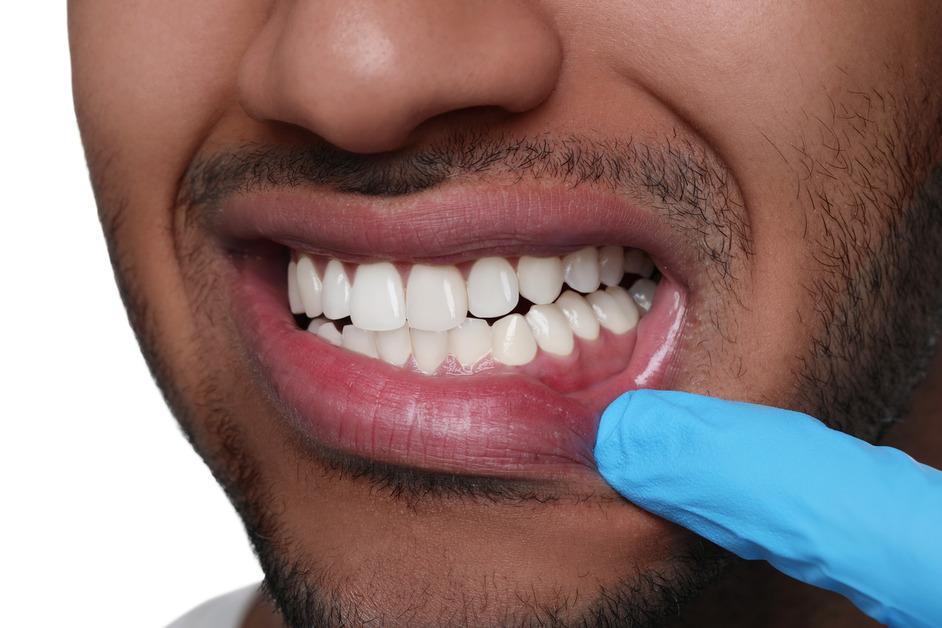 A close up of a man opening his mouth to show his teeth while a finger wearing a blue glove pulls down his lip. 