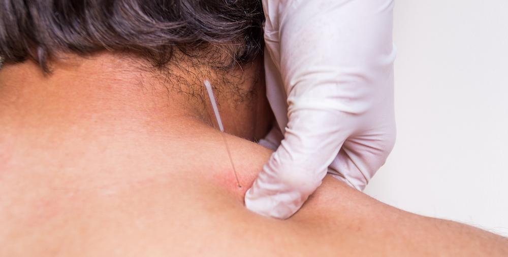 A close up of a needle being used for dry needling. 