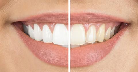 Simple ways to whiten your teeth