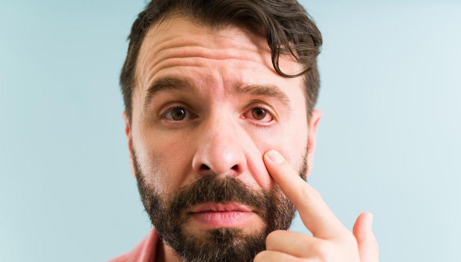 Why Are My Eyes Red When I Wake Up? Possible Reasons Here