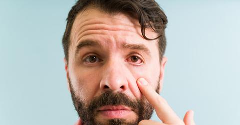 A man pulls down on the side of his face where his eye is red.