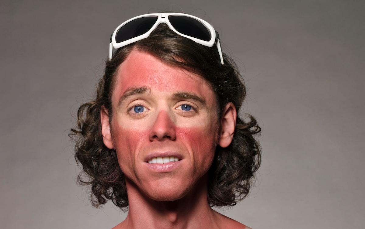 How to Heal Sunburn — Naturally