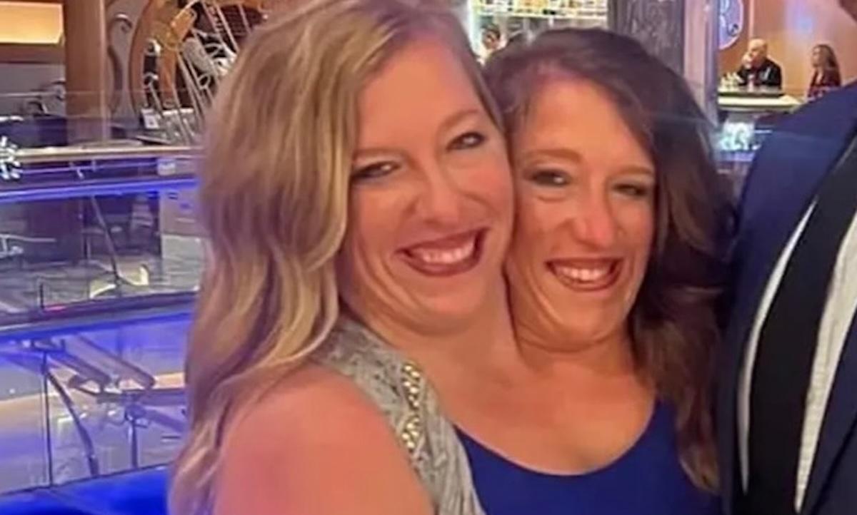 What Happens When One Conjoined Twin Dies?