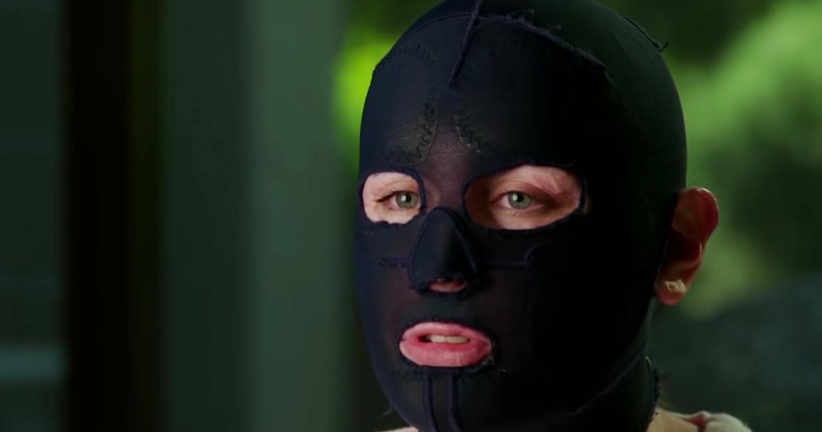 A still of Stephanie Browitt wearing a black face mask to protect her healing burns