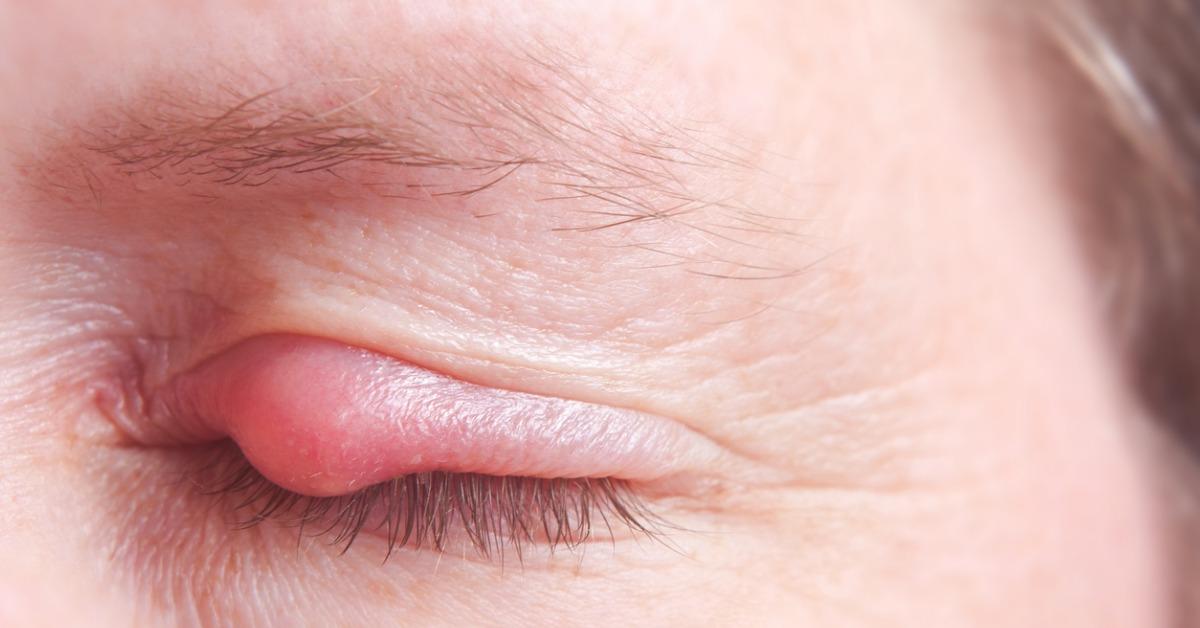 how to prevent styes how to treat styes