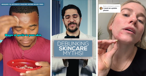 People have been rubbing raw garlic on their faces as a way to treat acne